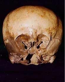 The Starchild skull